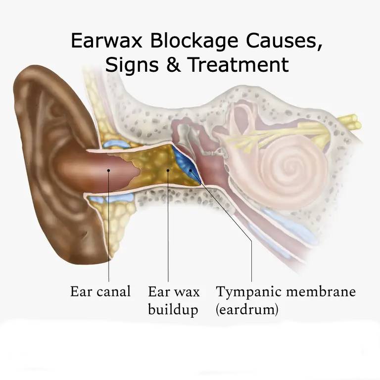 Earwax blockage removal treatment