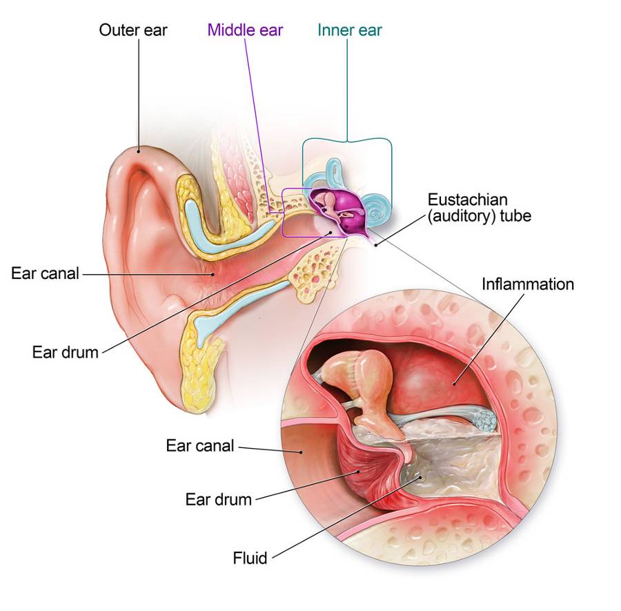 ear infection