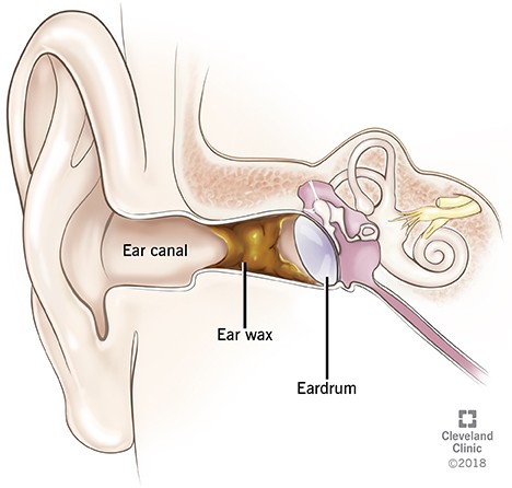 ear wax blockage