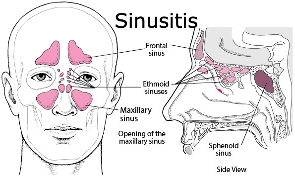 sinusitis symptoms, causes and treatment
